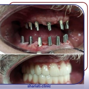 4نمونه کار ایمپلنت دندان | دکتر مهدی بمانعلی