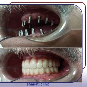 6نمونه کار ایمپلنت دندان | دکتر مهدی بمانعلی