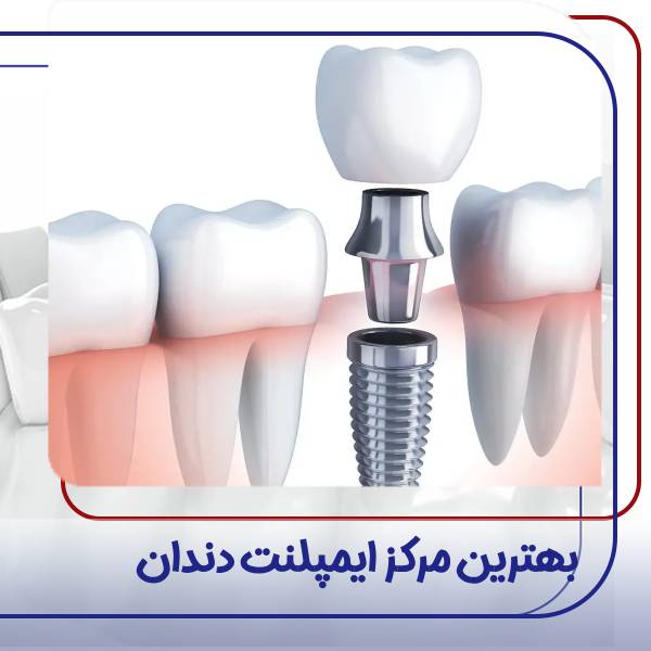 بهترین مرکز ایمپلنت کردن دندان