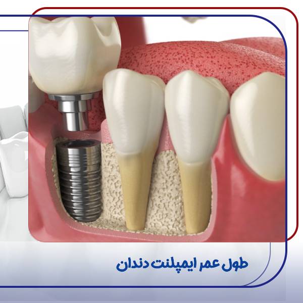طول عمر ایمپلنت دندان