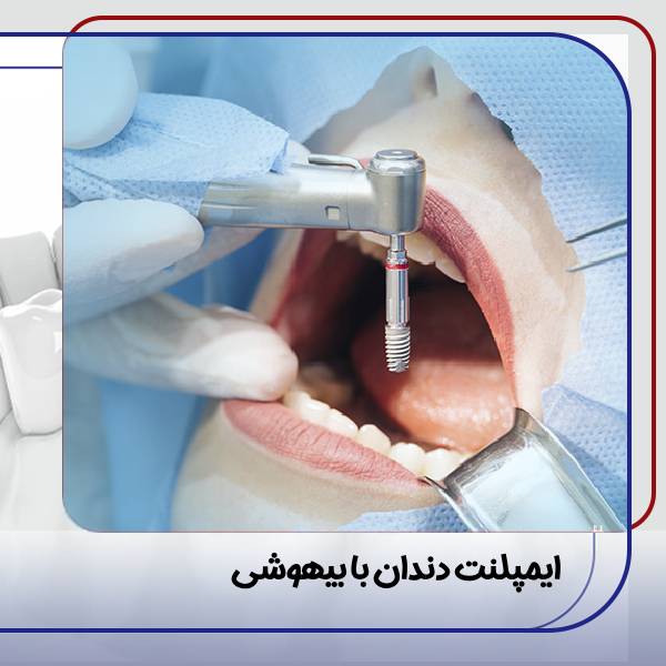ایمپلنت با بیهوشی