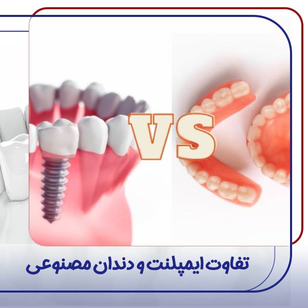 تفاوت ایمپلنت و دندان مصنوعی