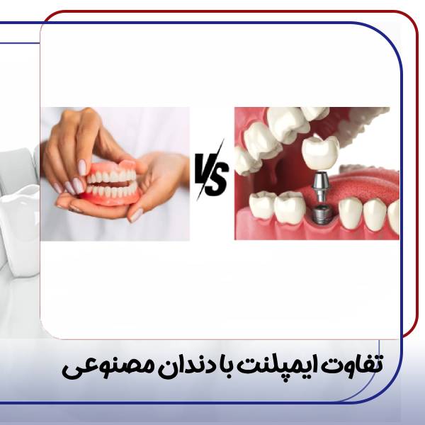 تفاوت ایمپلنت دندان با دندان مصنوعی