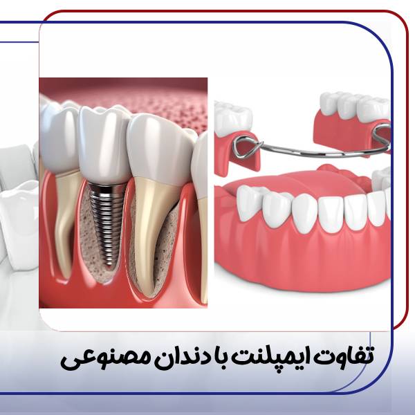 تفاوت ایمپلنت با دندان مصنوعی