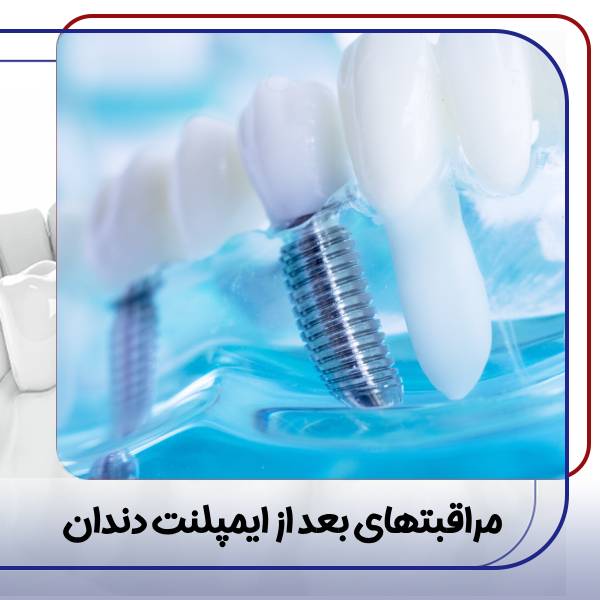 دوره نقاهت بعد از ایمپلنت دندان