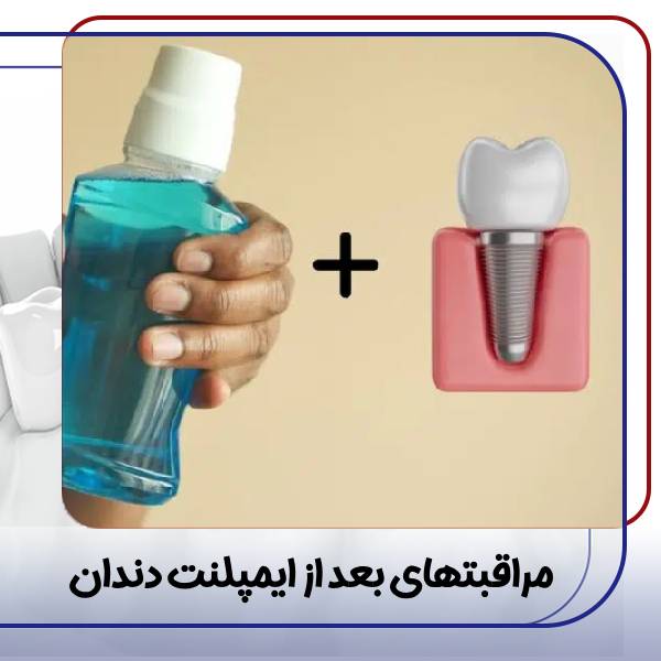مراقبت های بعد از ایمپلنت دندان