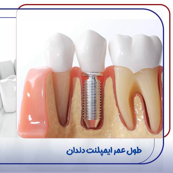 ماندگاری ایمپلنت دندان