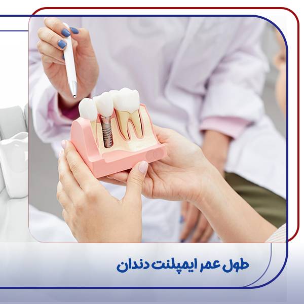 ماندگاری ایمپلنت دندان
