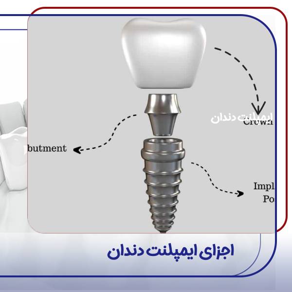 اجزای امپلنت دندان