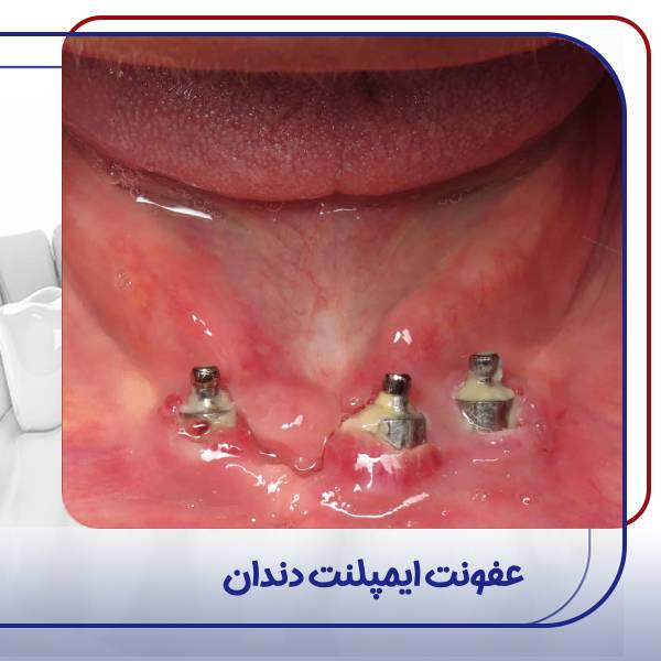 عفونت ایمپلنت دندان