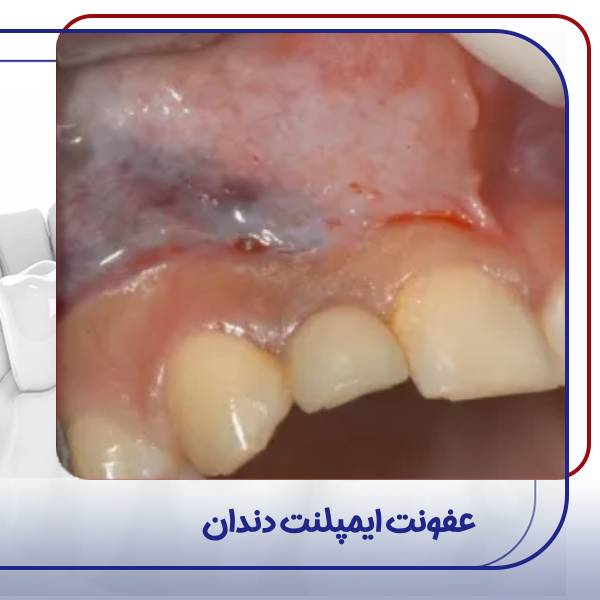 عکس عفونت ایمپلنت دندان