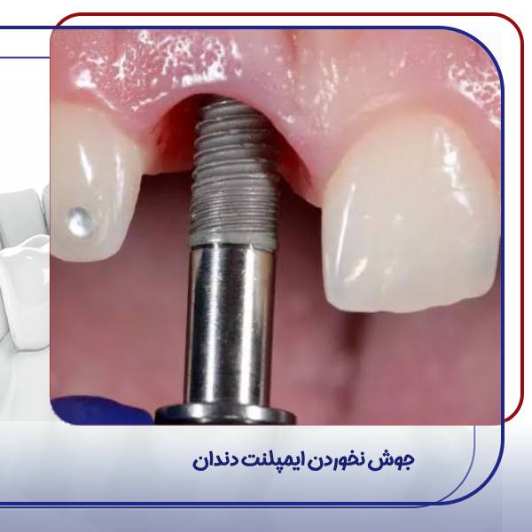 عکس پس زدن ایمپلنت 