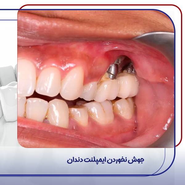 پس زدن ایمپلنت دندان