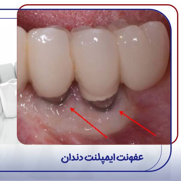 عفونت دندان