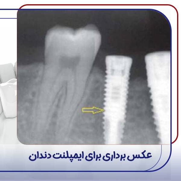 رادیوگرافی ایمپلنت دندان