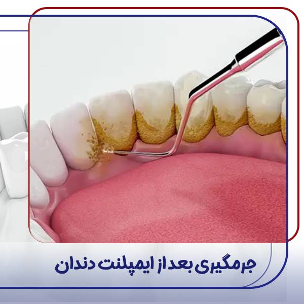 جرمگیری ایمپلنت دندان