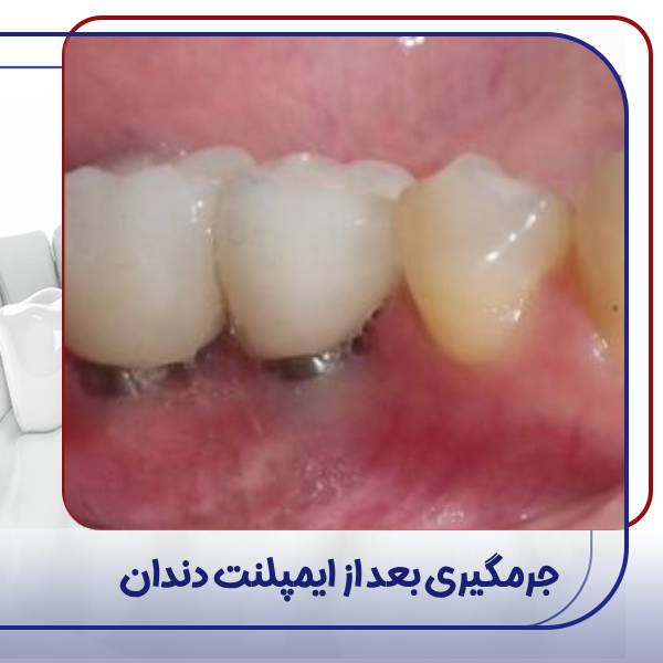 جرمگیری ایمپلنت