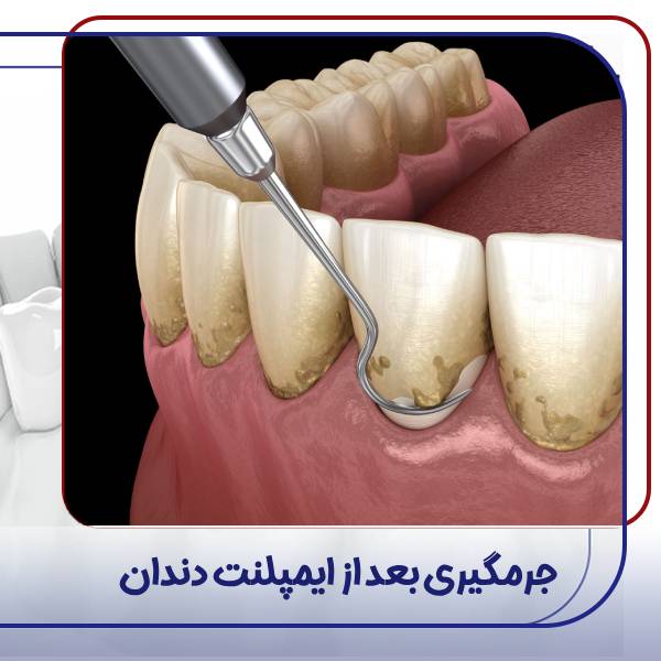 جرمگیری ایمپلنت دندان