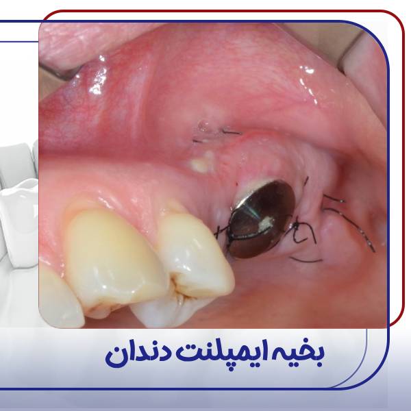 عکس ایمپلنت دندان