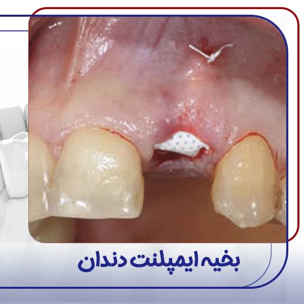 عکس ایمپلنت دندان
