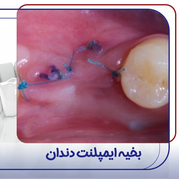 عکس بخیه ایمپلنت دندان