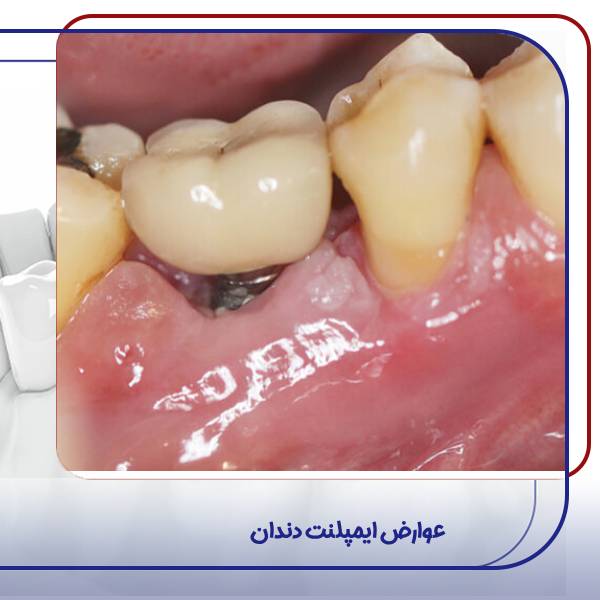 عوارض ایمپلنت دندان