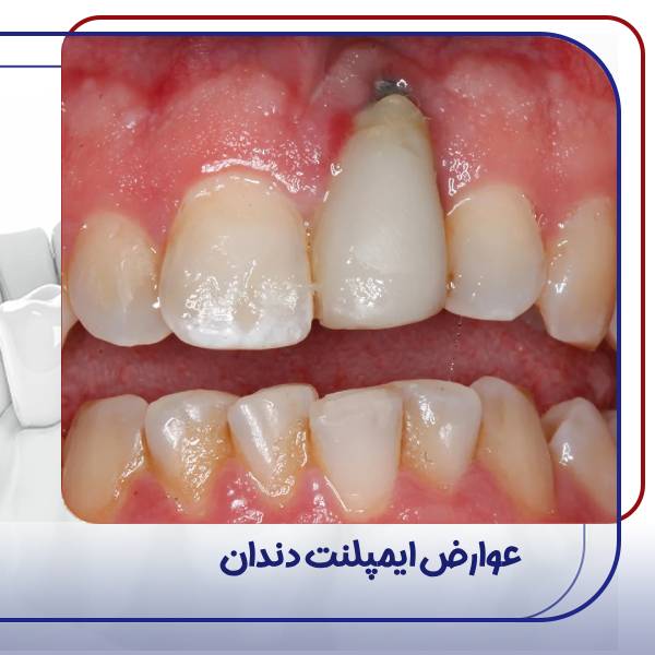 عوارض ایمپلنت دندان
