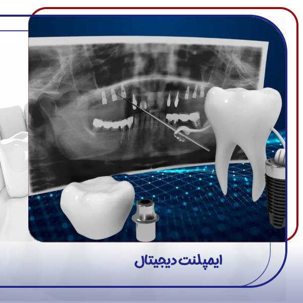 عکس ایمپلنت دیجیتال فوری