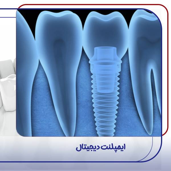 عکس ایمپلنت دیجیتال