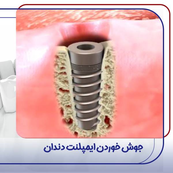 عکس جوش خوردن ایمپلنت دندان