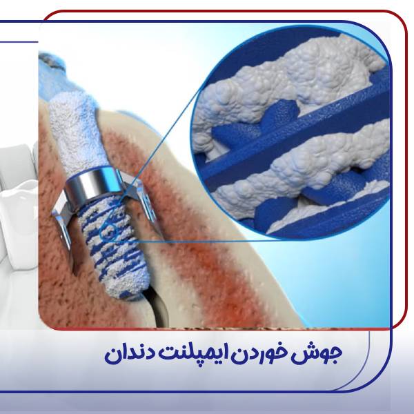 جوش خوردن ایمپلنت دندان