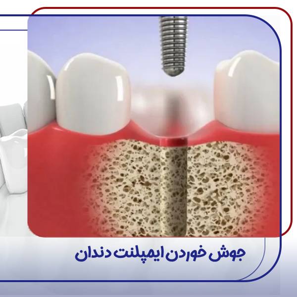 جوش خوردن ایمپلنت دندان