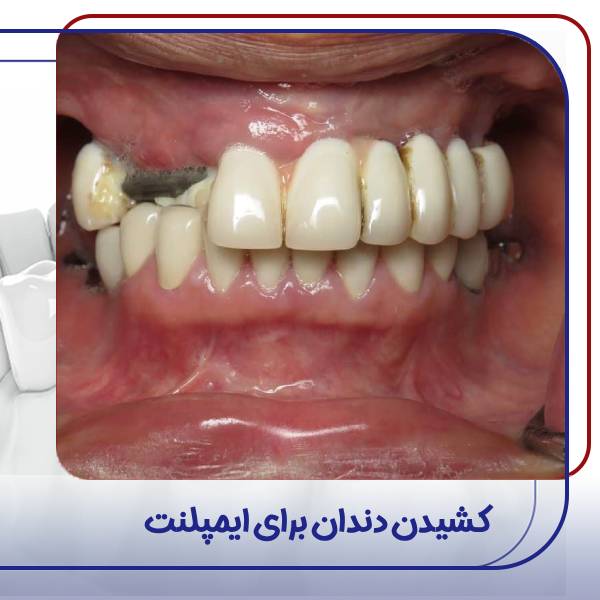 کشیدن دندان برای ایمپلنت کردن دندان