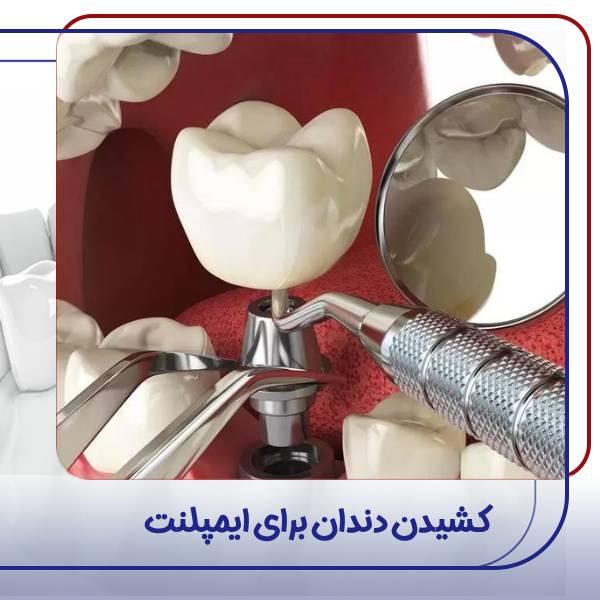 کشیدن دندان برای ایمپلنت