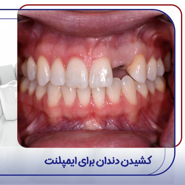 کشیدن دندان برای ایمپلنت