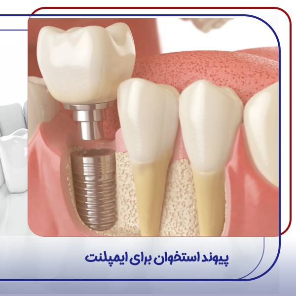 پیوند استخوان برای ایمپلنت