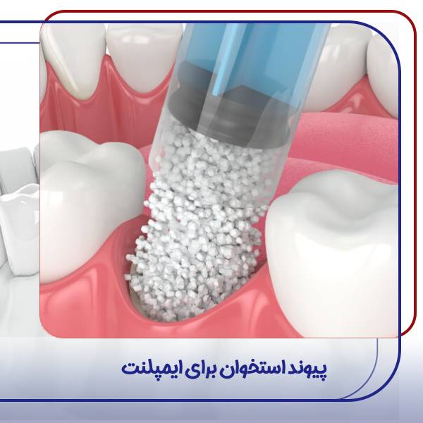 پیوند استخوان برای ایمپلنت