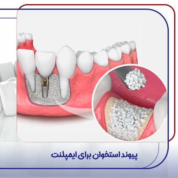 پیوند استخوان برای ایمپلنت
