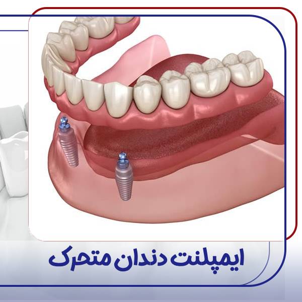 ایمپلنت متحرک
