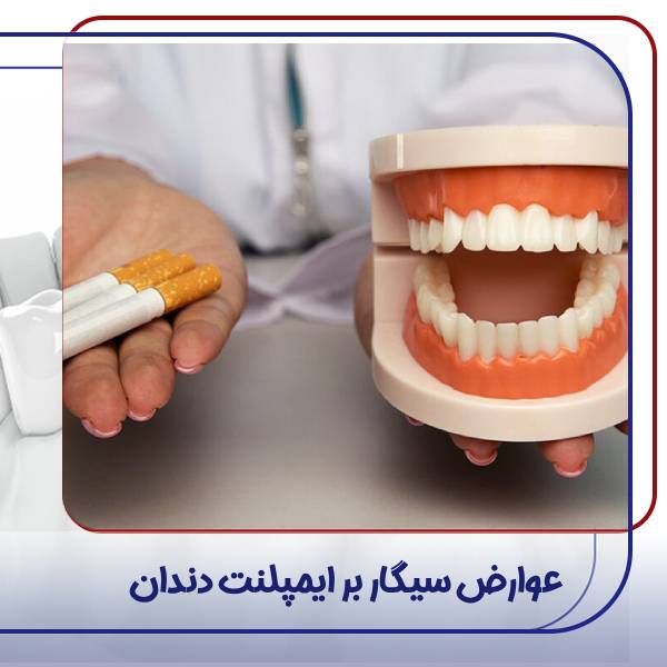 تاثیر سیگار بر ایمپلنت