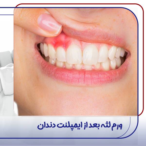 ورم لثه بعد از ایمپلنت