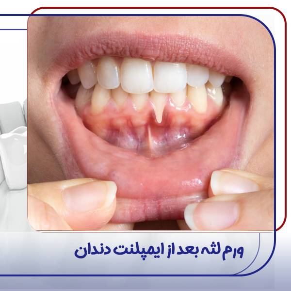 تورم لثه