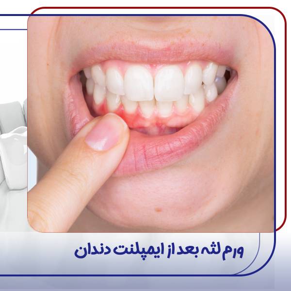 ورم لثه بعد از ایمپلنت دندان