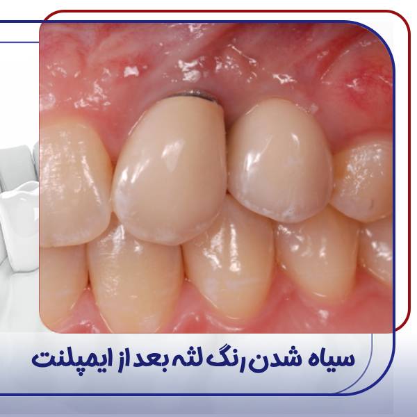 عکس تیرگی لثه بعد از ایمپلنت