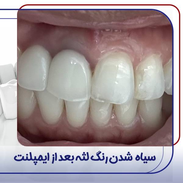 سیاه شدن رنگ لثه بعد از ایملنت دندان