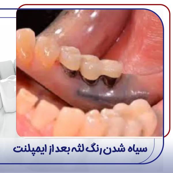 سیاه شدن لثه بعد از ایمپلنت