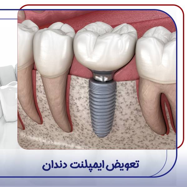 تعویض ایمپلنت دندان