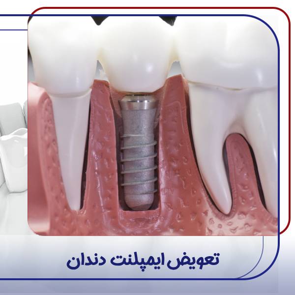 تعویض ایمپلنت دندان