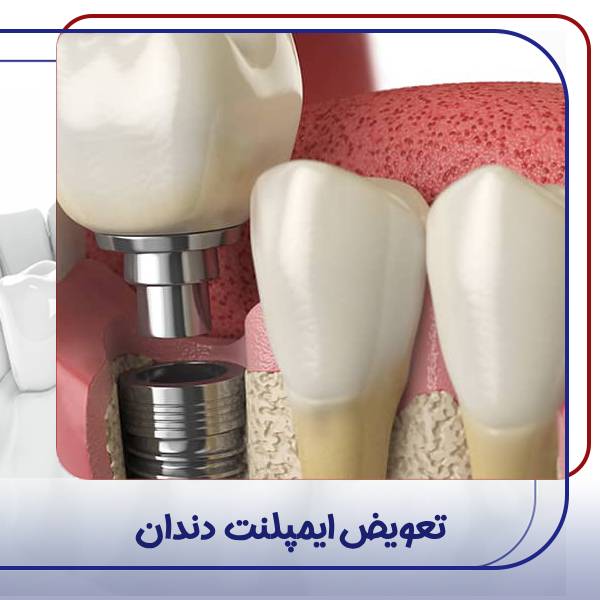 تعویض ایمپلنت دندان