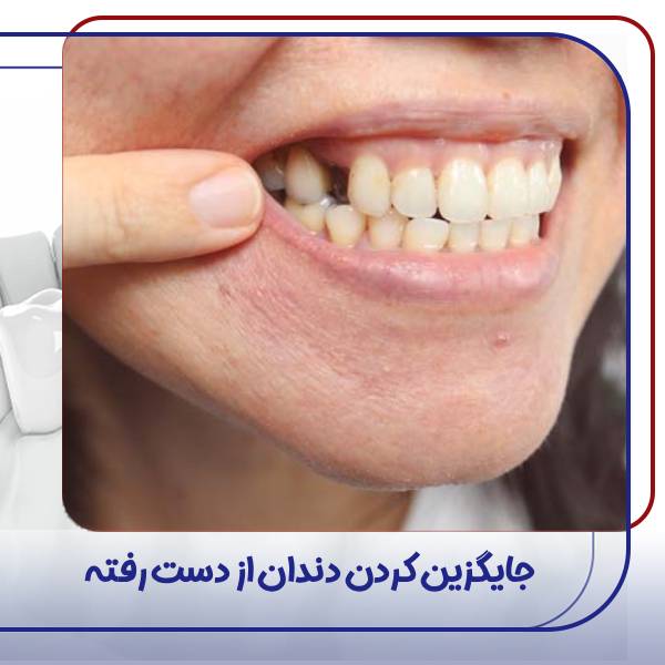 جایگزین کردن دندان از دست رفته